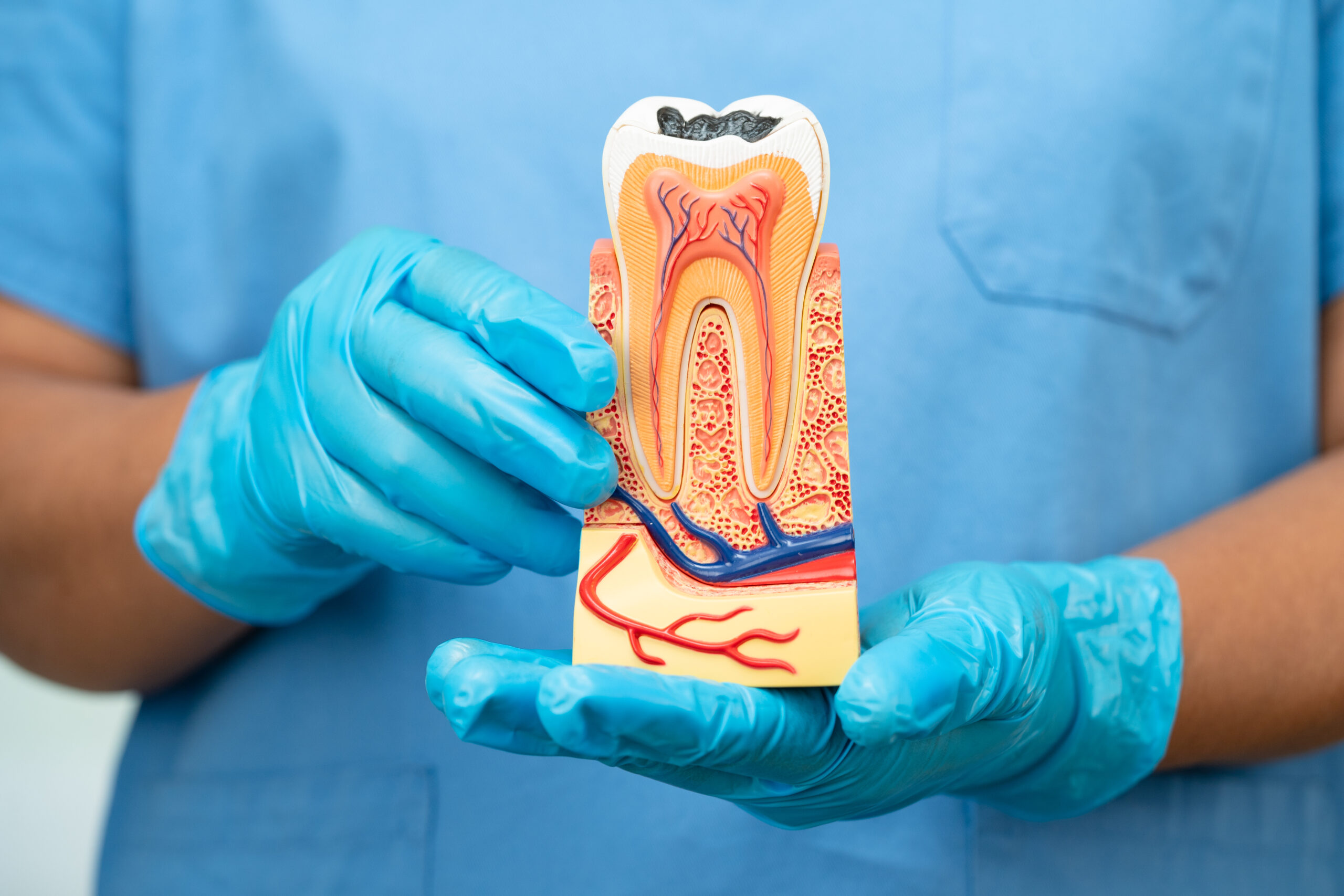 Dentist holding a teeth structure which showcases that root canal treatment is required