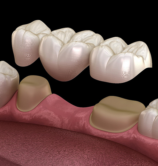 Crown and Bridges in Charlotte, NC - Regal Oaks Dental