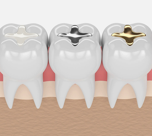 Dental Filling in Charlotte, NC - Regal Oaks Dental