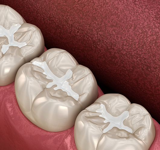 Dental Sealants in Charlotte, NC - Regal Oaks Dental
