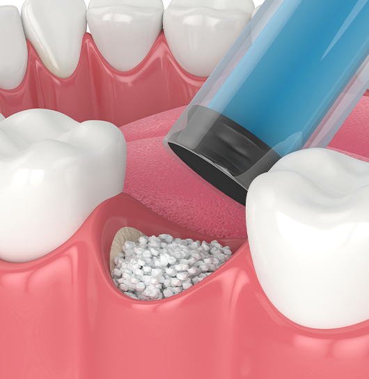 Fluoride Treatments in Charlotte, NC - Regal Oaks Dental