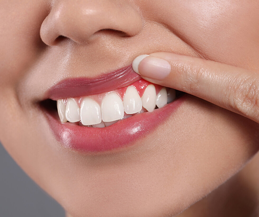 Gum Sculpting in Charlotte, NC - Regal Oaks Dental