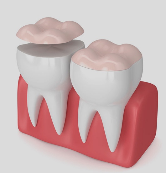 Inlays and Onlays in Charlotte, NC - Regal Oaks Dental