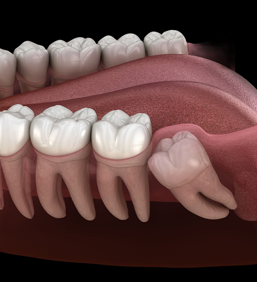 Wisdom Teeth Removal in Charlotte, NC - Regal Oaks Dental