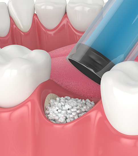 Bone Grafting in Howell, NJ