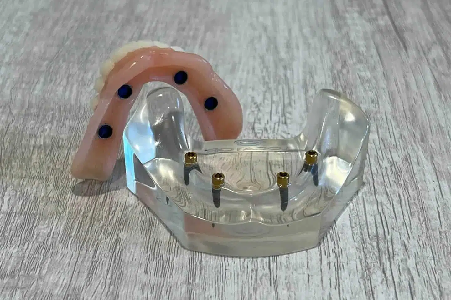 Cost of Dental Implants in Howell, NJ
