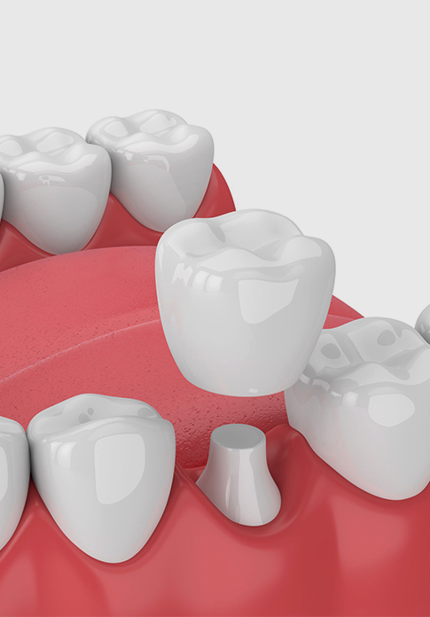 Dental Crowns and Bridges in Howell, NJ