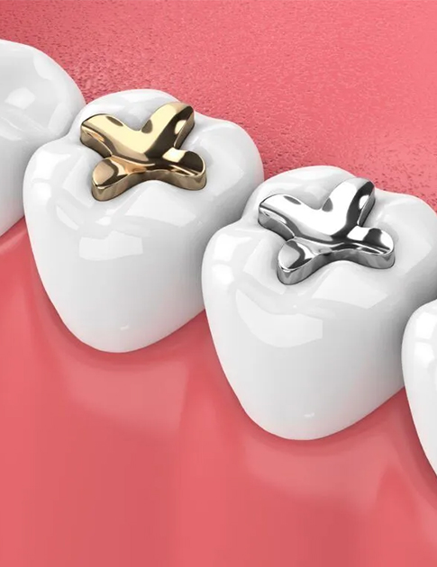 Dental Fillings in Howell, NJ