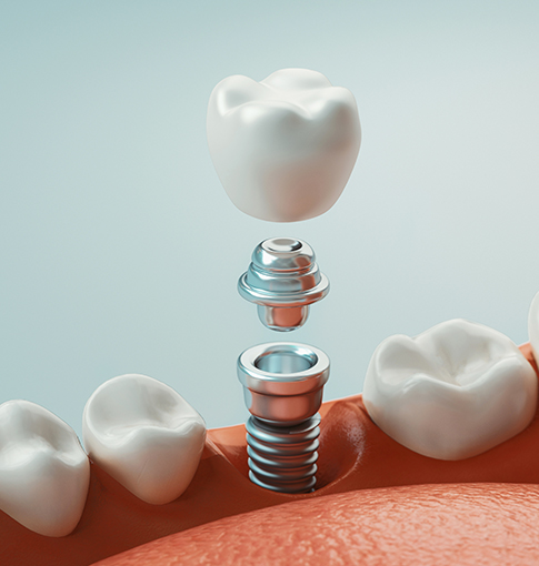 Dental Implants in Howell, NJ