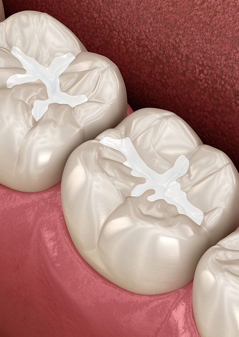 Dental Sealants in Howell, NJ