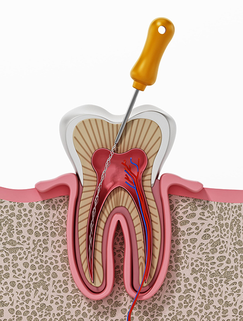 Root Canals in Howell, NJ