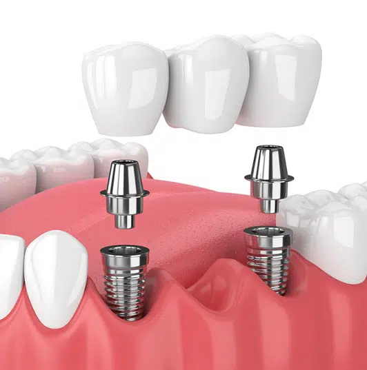 Single Tooth Implants and Bridges in Howell, NJ