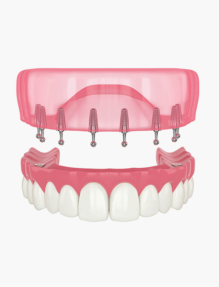 Snap-in Implant Dentures in Howell, NJ