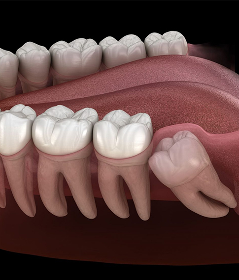 Wisdom Tooth Extractions in Howell, NJ