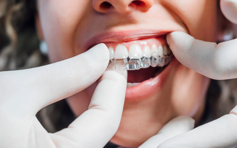 How Invisalign Perfects Your Smile