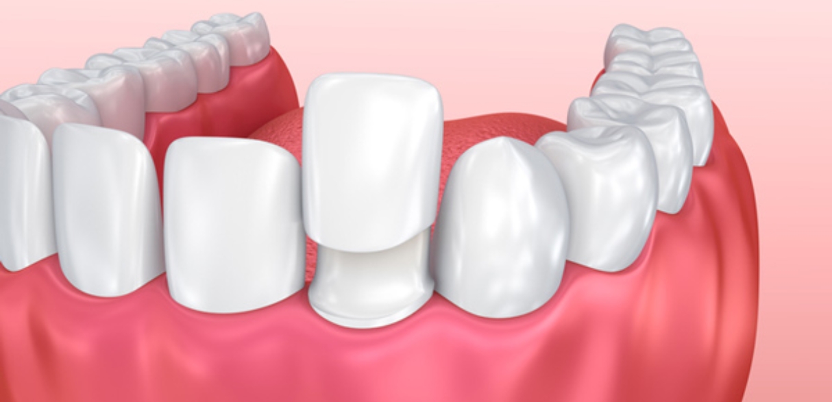 Common Issues with Dental Veneers and How to Fix Them