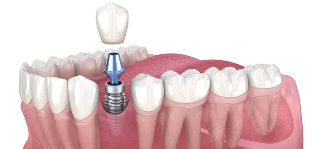 How Long Do Dental Implants Last