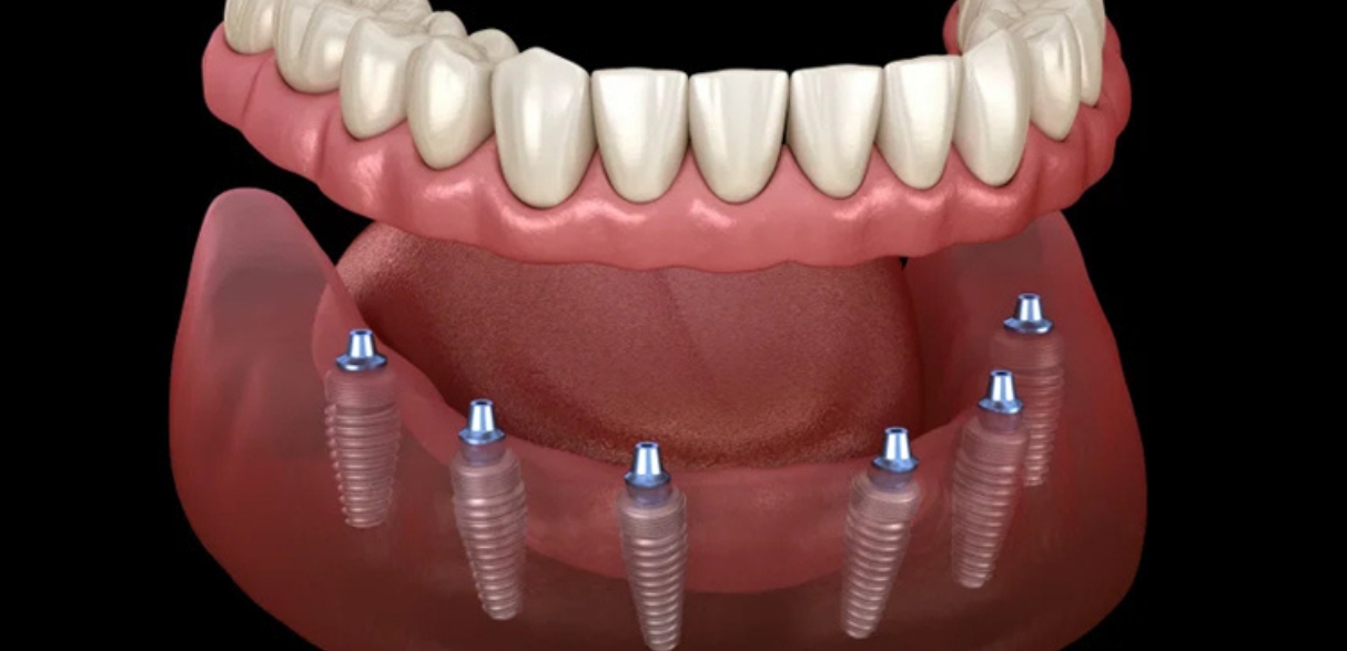 Why Dental Implants Are the Best Solution for Missing Teeth