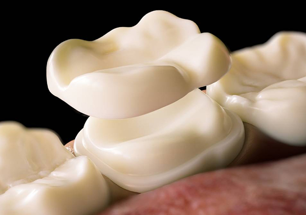 Porcelain Dental Restorations in San Jose, CA