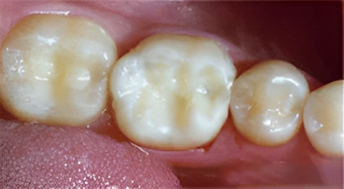 Dental Bonding and Fillings in San Jose, CA - After Treatment