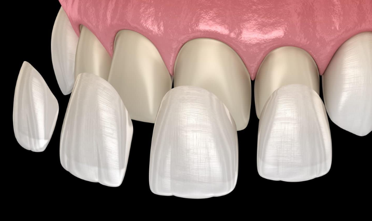 Porcelain Veneers