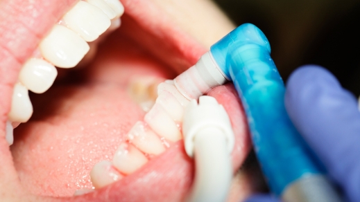Why Smokers Need More Frequent Dental Cleanings?