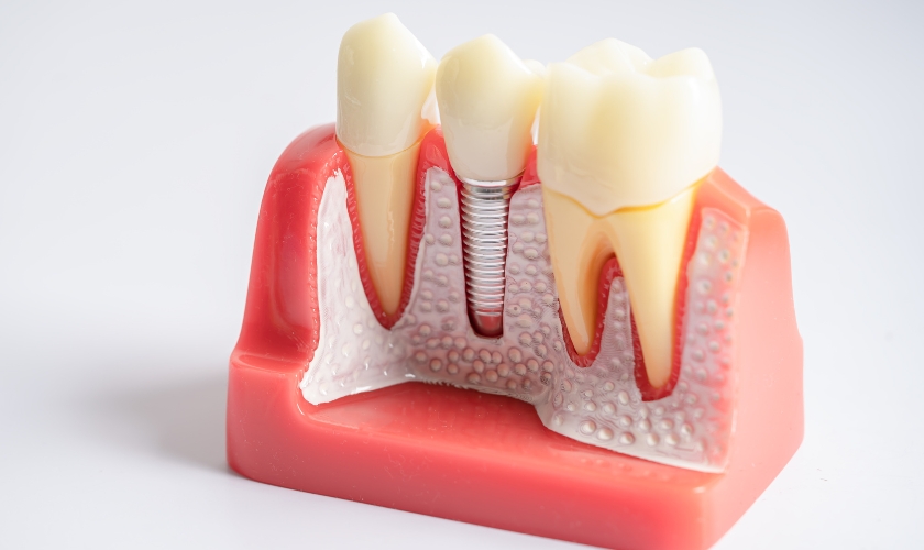 how long do implants last in teeth