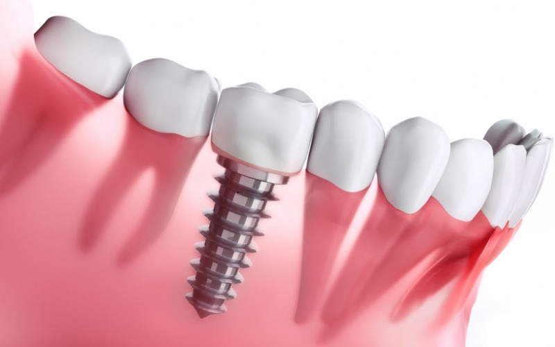 who is the right candidate for dental implants