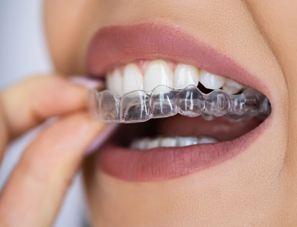 Clear Aligners Seattle